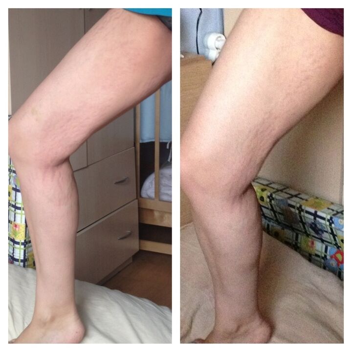 коляно преди и след
